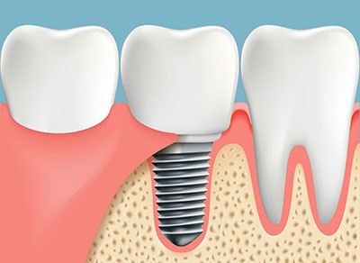 Dental implants Delta BC